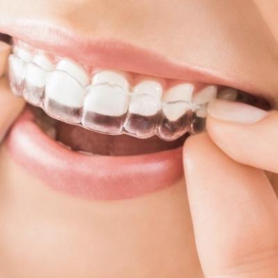 Niềng răng trong suốt là gì? - Cập nhật báo giá niềng răng trong suốt tại Nha Khoa VIPLAB mới nhất