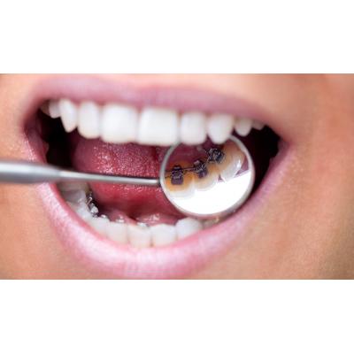 Tìm hiểu các loại mắc cài niềng răng phổ biến hiện nay