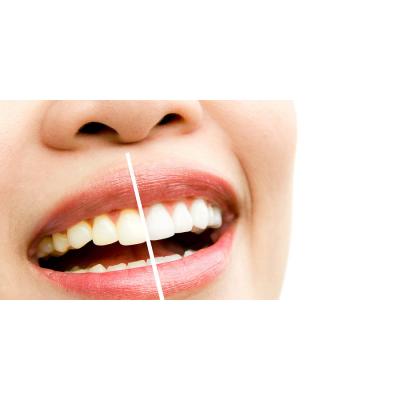 Có nên tẩy trắng răng sau khi gắn đá không?