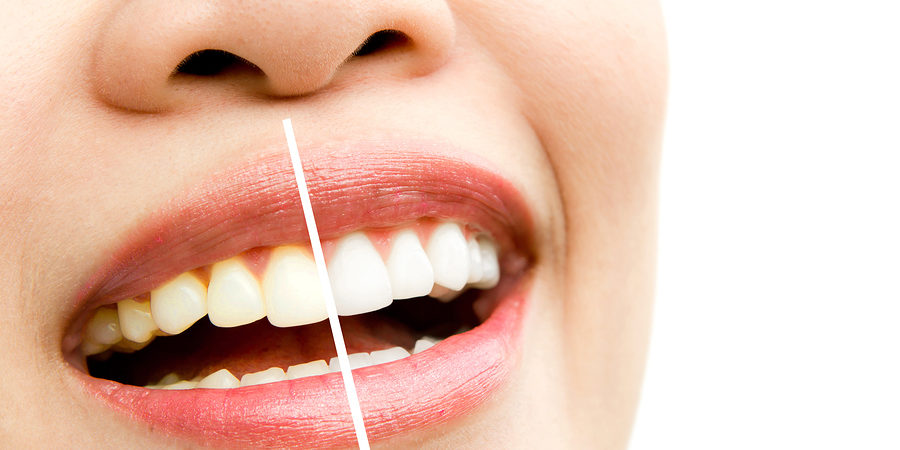 Có nên tẩy trắng răng sau khi gắn đá không?